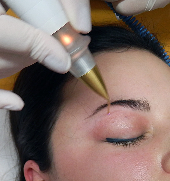 Miniinvazivní blepharoplastika