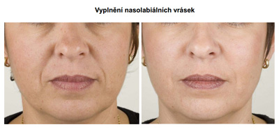 Vyplnění nasolabiálních vrásek
